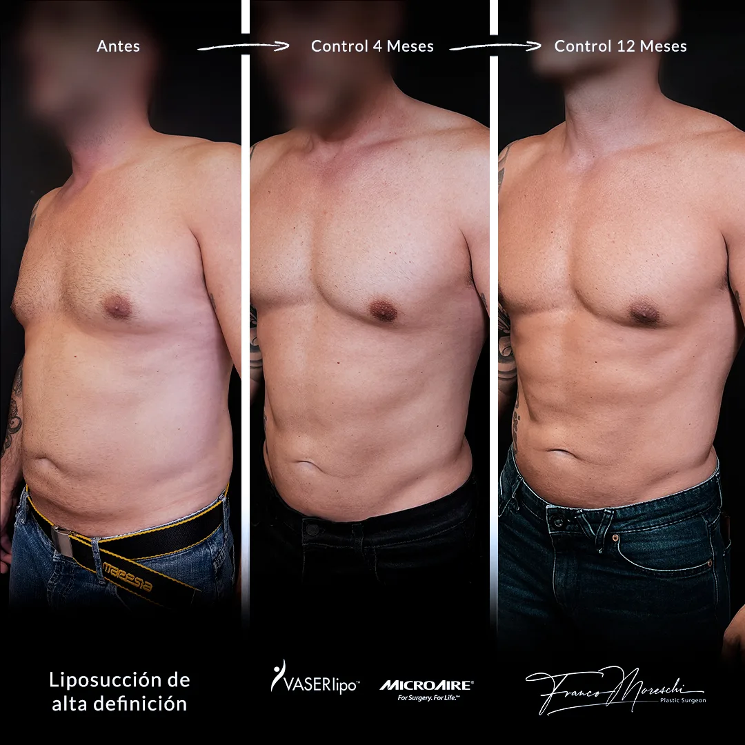 FM_liposuccion-Javier-3-controles---A